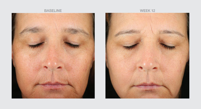 Retinol + Bakuchiol Serum 5x